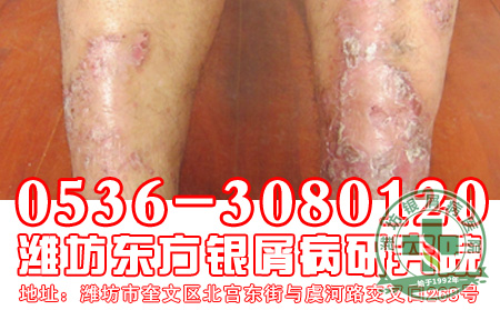 银屑病患者的心理治疗要怎样做好？