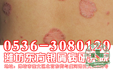 预防银屑病出现复发，患者应该做好哪些？