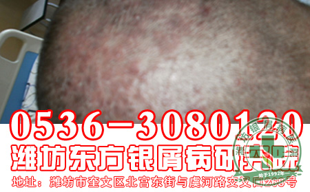 银屑病患者治疗时为什么要慎用偏方？