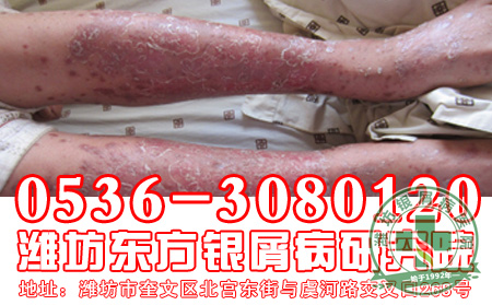 银屑病怎样进行治疗 好?