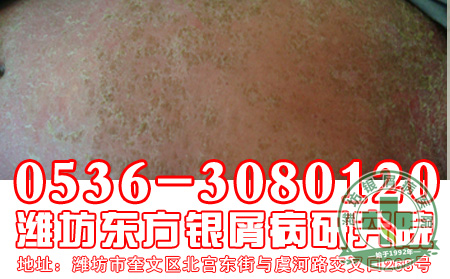 银屑病的发病与患者的什么因素有关系?