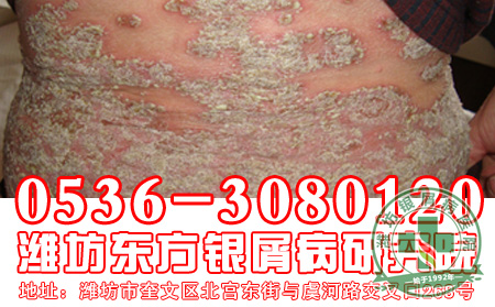 银屑病发病的初期症状是怎么样的?