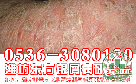 银屑病患者的饮食工作要怎样做 好?