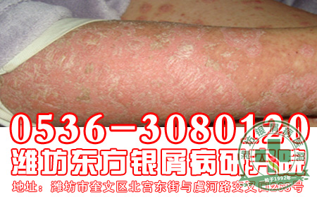 银屑病会给患者造成哪一些危害？