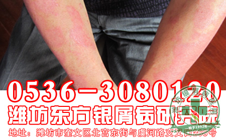 银屑病患者的饮食工作应该怎样做?