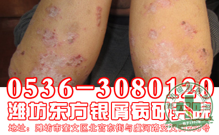 银屑病的初期症状是什么样子的?