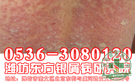 牛皮癣的护理工作应该做到那些？
