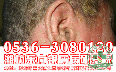 牛皮癣患者食用哪些食物是 好的?