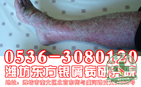 患者对于红皮型银屑病这种严重银屑病类型,应