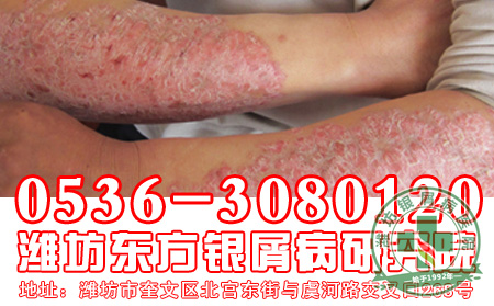 对于银屑病的发病症状表现，患者应该如何应对