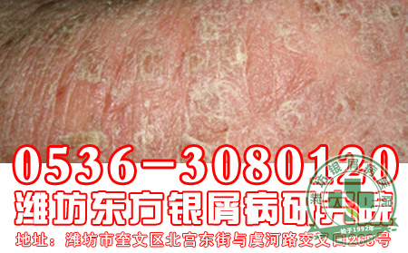 银屑病患者的饮食工作要怎样做好?