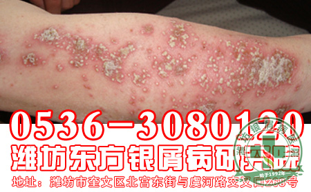 怎样正确对待银屑病患者的心理精神因素？