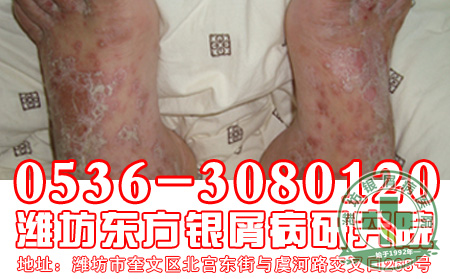 银屑病的发病阶段有什么表现?