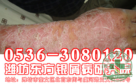 秋季到了,患者对于银屑病的病情要注意什么?