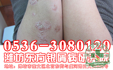 银屑病患者应该吃什么？不吃什么？