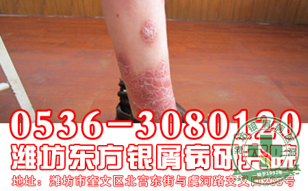 脓疱型银屑病患者可以多吃哪些食物？-济南牛皮