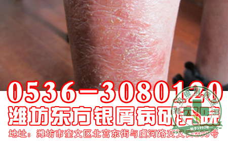 银屑病患者的心理因素要注意什么问题?