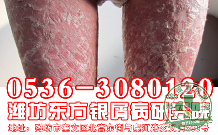 红皮型银屑病的遗传有什么特征表现?