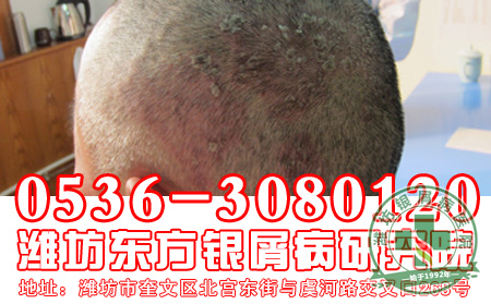银屑病的治疗需要注意的禁忌有什么?