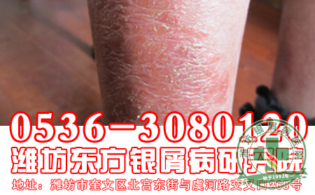 红皮型银屑病的发病症状是怎么样的？