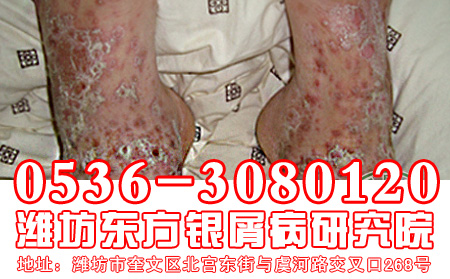 老年牛皮癣发病的表现是什么样的？