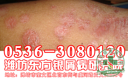 牛皮癣会给患者的身体造成哪些危害？
