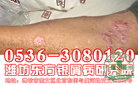 牛皮癣的偏方使用要注意什么问题？
