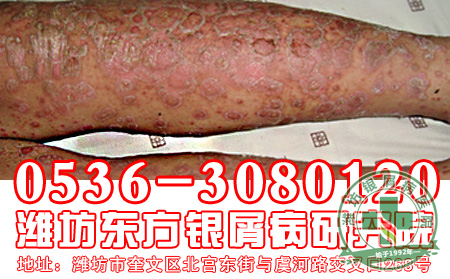 患者针对银屑病的复发应该怎样做？
