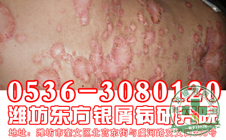 银屑病治疗要怎样使用偏方?
