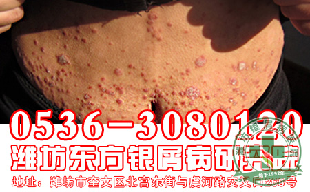 银屑病的治疗要如何注意药物的使用?