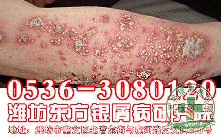 银屑病发病后会给患者造成什么伤害？