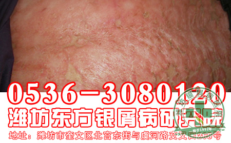 寻常型银屑病发病后会出现的症状是怎样的?