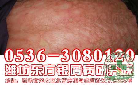 对于银屑病的用药问题,患者要注意什么