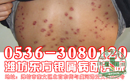 对于银屑病的预防工作,银屑病患者你都知道吗