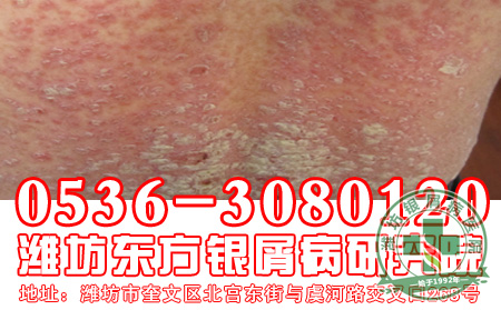 对于银屑病的治疗,患者要注意哪几点