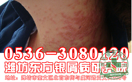 减少银屑病的复发,患者应该注意什么