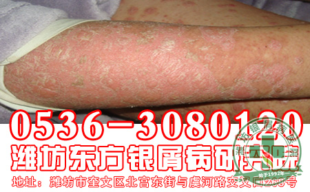 银屑病真的会遗传,你知道怎么应对吗