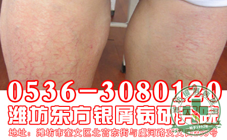 患者对于银屑病的护理工作要注意什么?