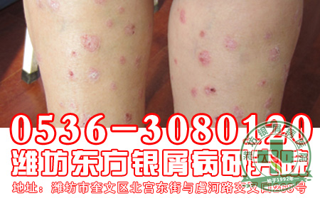 银屑病患者的饮食工作应该怎样做才好?