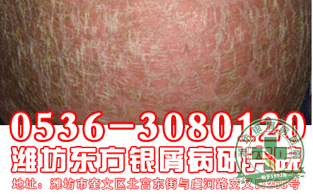 患者对于牛皮癣的遗传应该注意什么问题