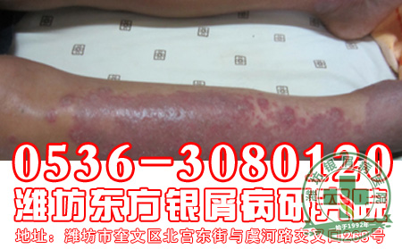 银屑病患者的遗传要注意什么问题?
