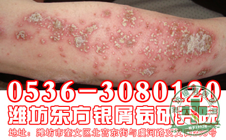 银屑病的治疗和用药应该注意什么?