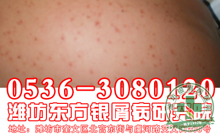 银屑病患者的遗传是绝对的?