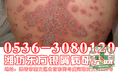 哪些因素是银屑病复发的真凶？