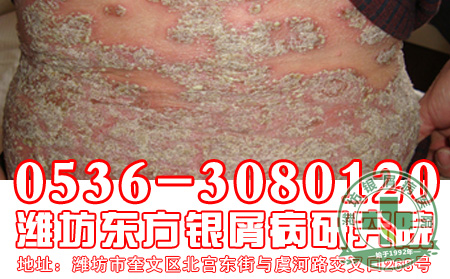 怎样做有助于减小银屑病的遗传几率?