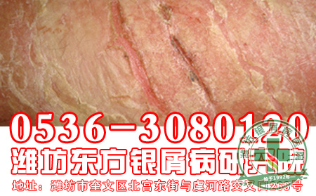 银屑病患者的心理治疗怎样做 好?