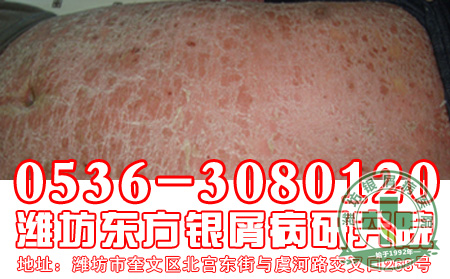 银屑病患者的发病,患者你知道与什么有关系吗