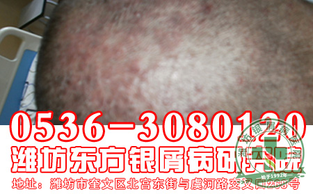 对于银屑病的遗传患者应该注意什么?