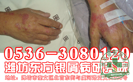银屑病的偏方使用要注意什么？