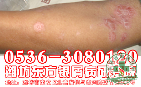 银屑病患者应该怎样注意治疗银屑病?